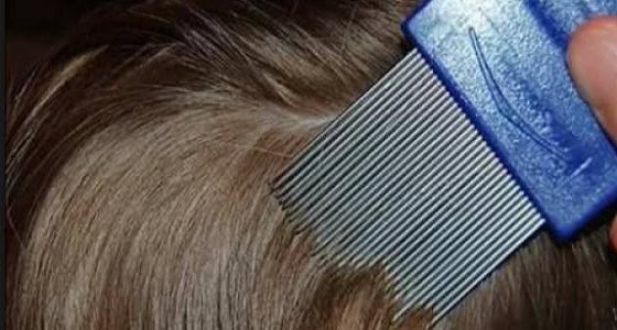 مواد طبيعية تنسف حشرات الشعر نهائيا