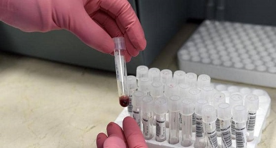 للمرة الأولى.. إزالة فيروس نقص المناعة من جينات حية