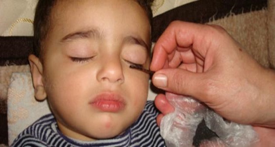 استشاري أمراض جلدية : تكحيل عين طفلك قد تؤدي إلى العمى