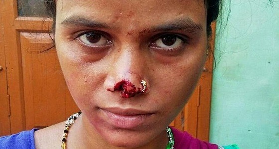 رجل يقطع أنف زوجته بآلة حادة ويخالف قانون الطلاق