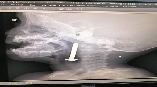 جراحة ناجحة لإنقاذ حياة طفل إبتلع مسمار حديدي