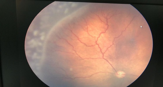 نجاح عملية لعيون طفلة بمجمع الملك فيصل بالطائف