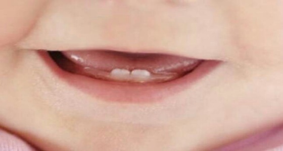 أسباب ضعف &#8221; الأسنان اللبنية &#8221; للطفل وطرق الحفاظ عليها
