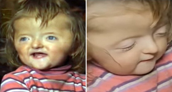 روضة ترفض قبول طفلة لأنها من ذوي الإعاقة وستُخيف الأطفال!