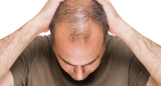 الصحة: علاج تساقط الشعر يعتمد على 3 عوامل