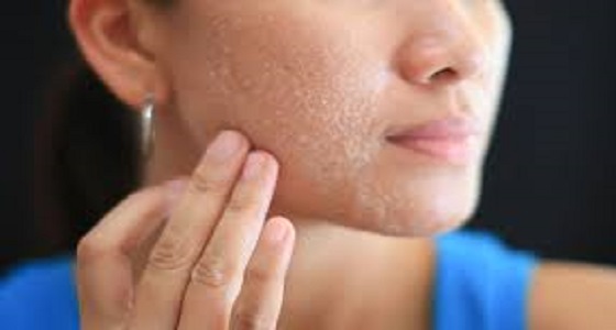 لبشرة ناعمة.. طرق سهلة وفعالة لعلاج قشرة الوجه