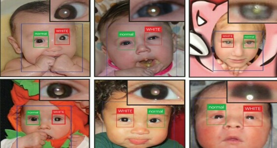 تطبيق جديد يكتشف مرض نادر لسرطان العيون قبل الأطباء