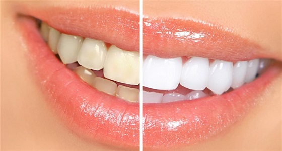 10 طرق طبيعية لإزالة جير الأسنان 
