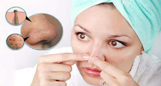 وصفات طبيعية للتغلب على مشكلة «الرؤوس السوداء»