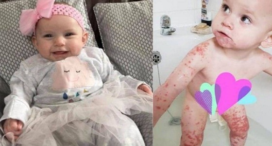 احذري.. مرض جلدي يهاجم طفلة بعد تقبيلها على وجهها