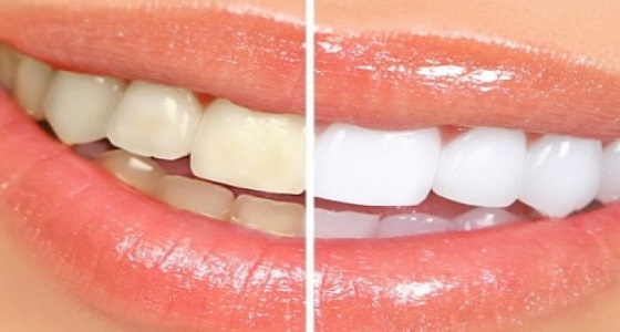 منها شرب الماء بالليمون.. أخطاء شائعة تسبب إصفرار الأسنان