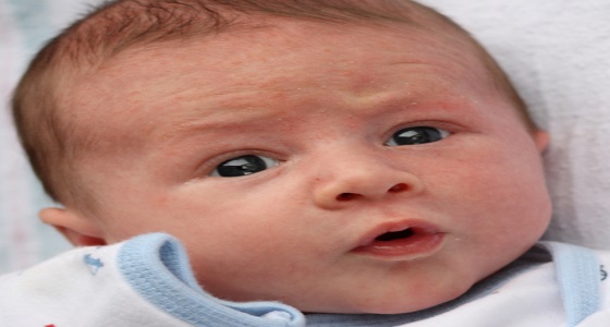 حب الشباب لدى الأطفال وطرق علاجه