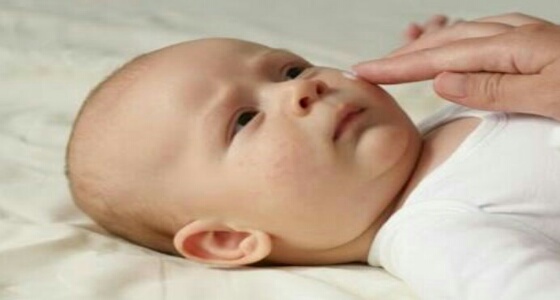 تعرفي على أسباب ظهور «حب الشباب» لدى رضيعك وكيفية علاجه