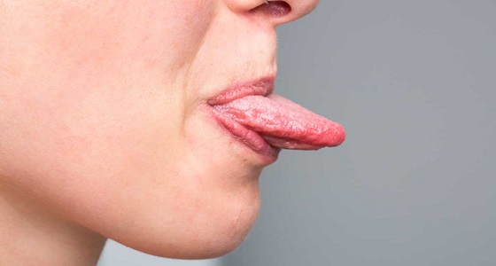 الطبقة البيضاء على اللسان تنذر بمرض خطير ونادر  