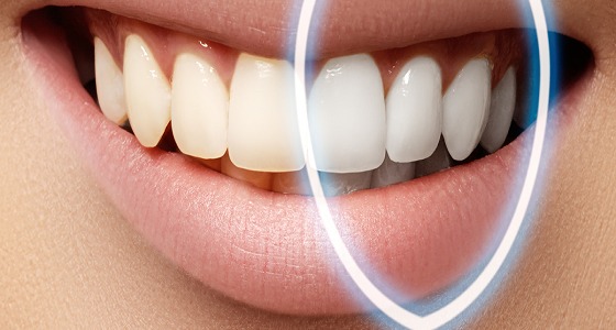 «حروق الأنسجة».. مخاطر تبييض الأسنان