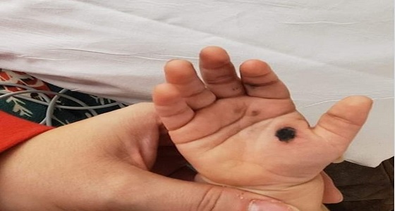 طفلة تتعرض لصعق كهربائي بسبب شاحن الجوال 