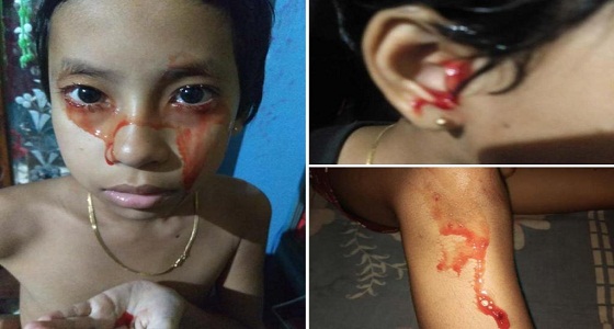 شاهد.. طفلة تبكي وتتعرق دمًا من كافة أنحاء جسدها