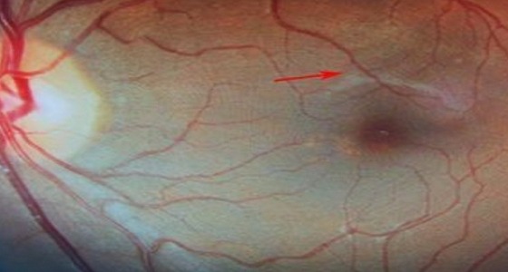 طبيب عيون ينشر صورة مريض نظر للشمس أثناء الكسوف