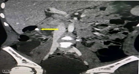 مجلة طبية عالمية تستعرض نجاح حالة نادرة بمستشفى الملك خالد بالمجمعة