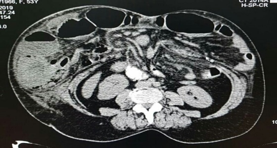 سبب لها انسدادا معويا.. «مريضة» تتعرض لفتق كبير بالأمعاء في ينبع