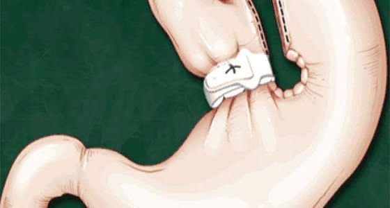 استشاري: عمليات تدبيس وطي المعدة أثبتت فشلها بشكل كبير (فيديو)