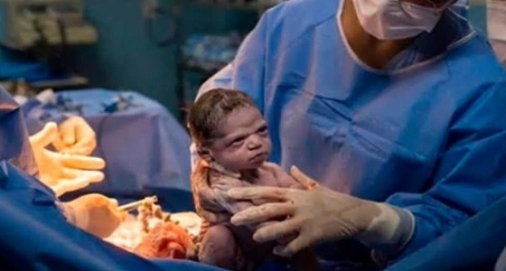 بالصورة.. لقطة عجيبة لطفلة «تلوم» طبيبها لحظة الولادة