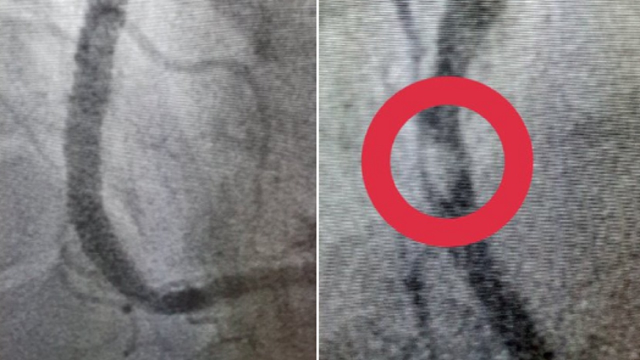 مريض يُصاب بجلطة حادة لإيقافه الأسبرين منذ سنتين (صور)