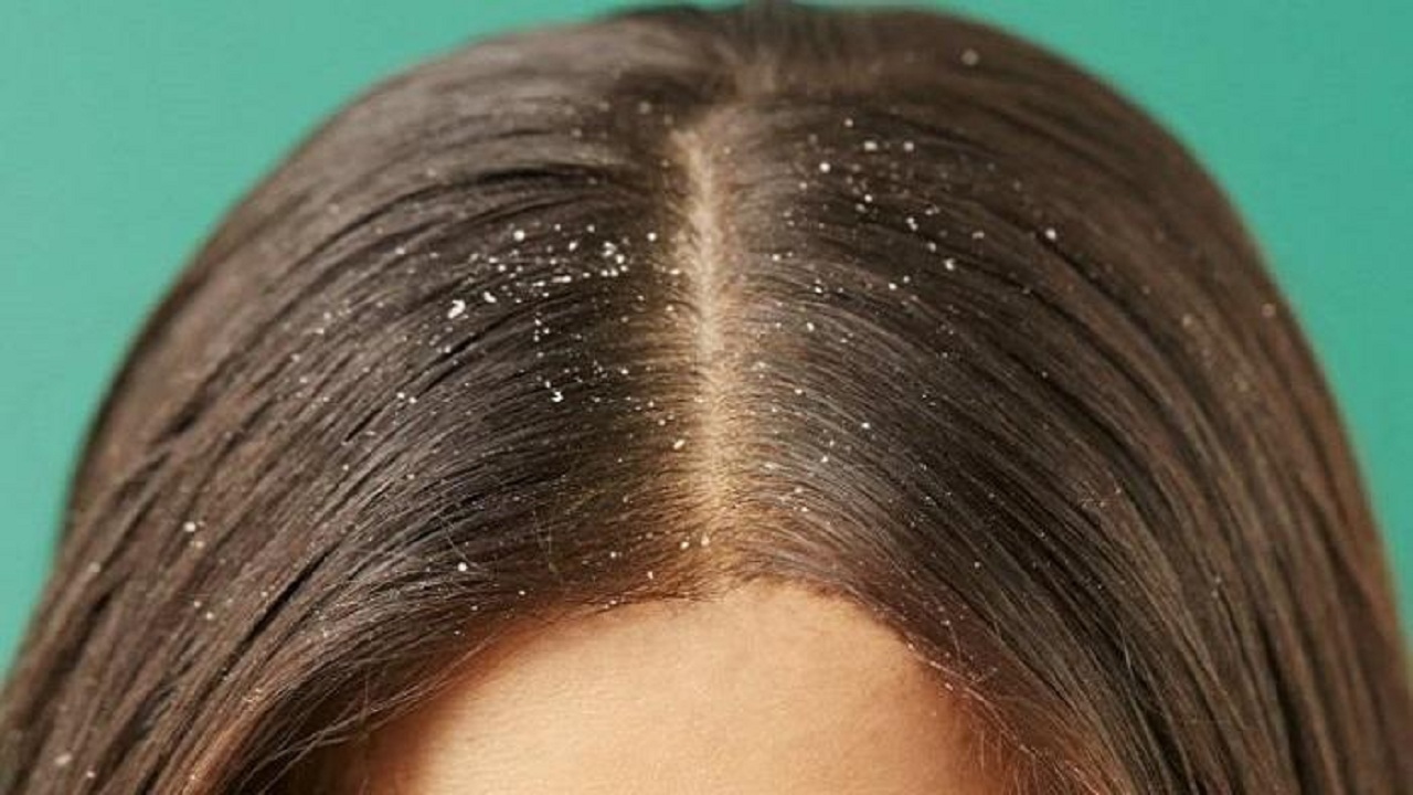 تعرف على طريقة التخلص من قشرة الشعر بوصفة طبيعية