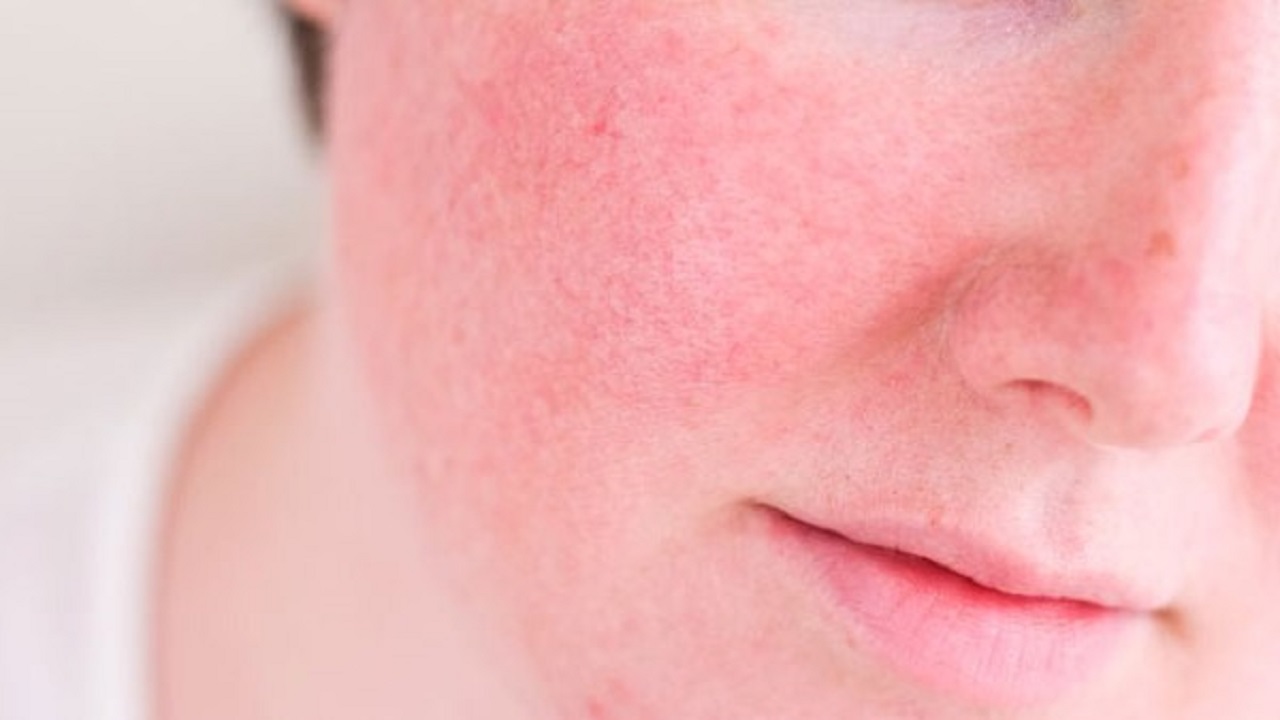 4 نصائح لعلاج  احمرار الجلد وتقشره أثناء الصيف