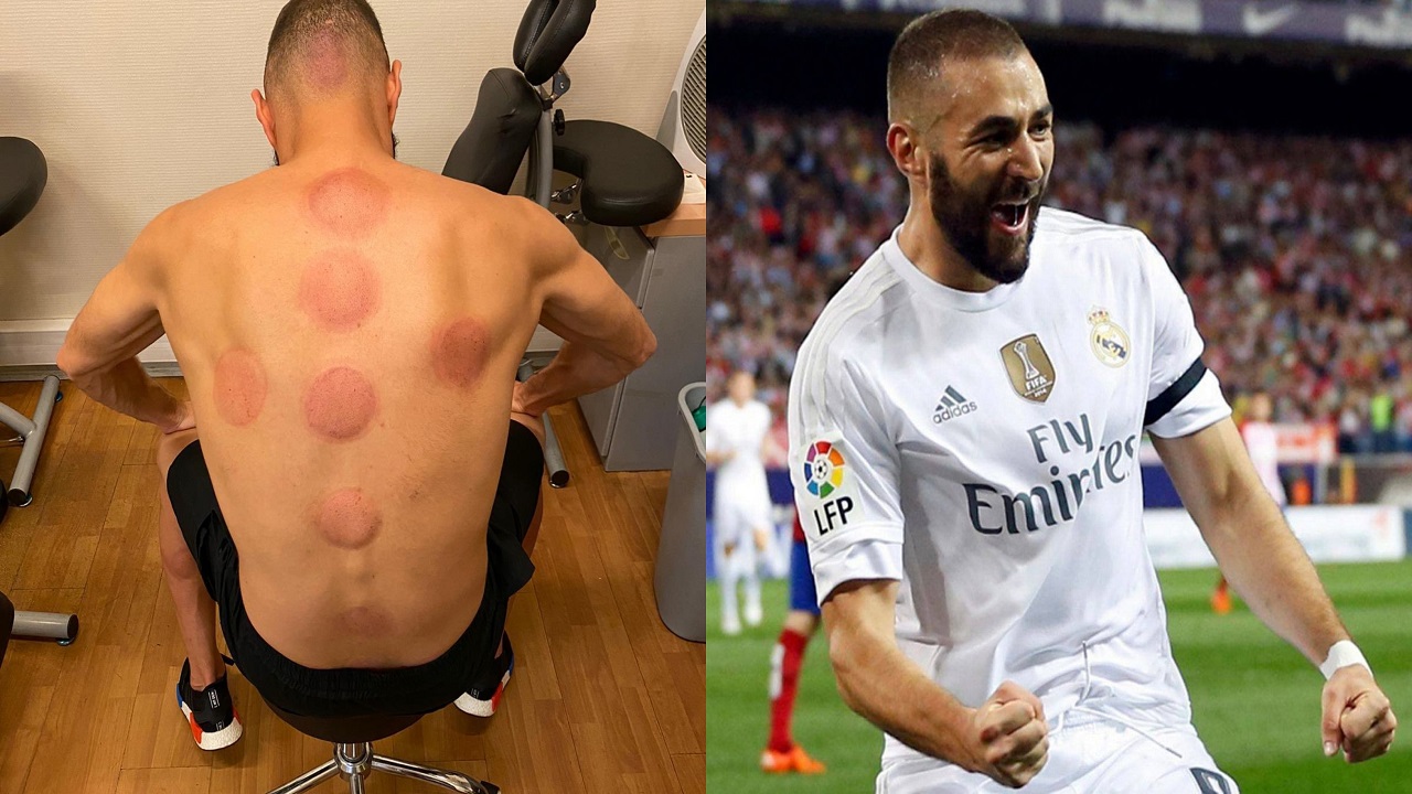 لاعب ريال مدريد يخوض تجربة التعافي بالحجامة