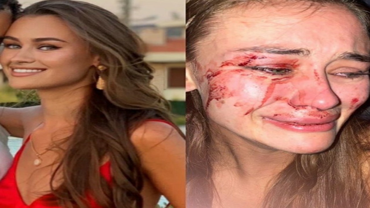 عارضة أزياء شهيرة تتعرض للضرب المبرح على أحد الشواطئ التركية 