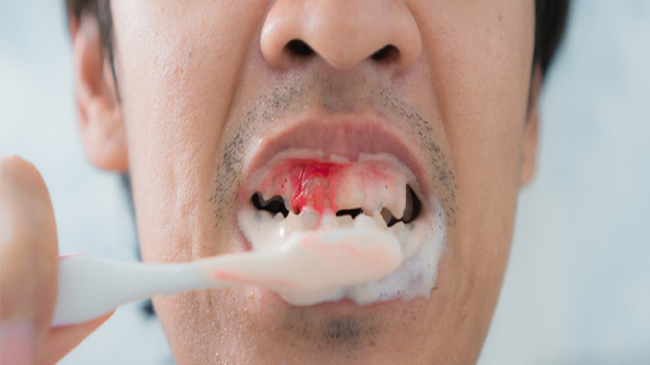 أسباب نزيف اللثة عند غسيل الأسنان وطرق الوقاية منه