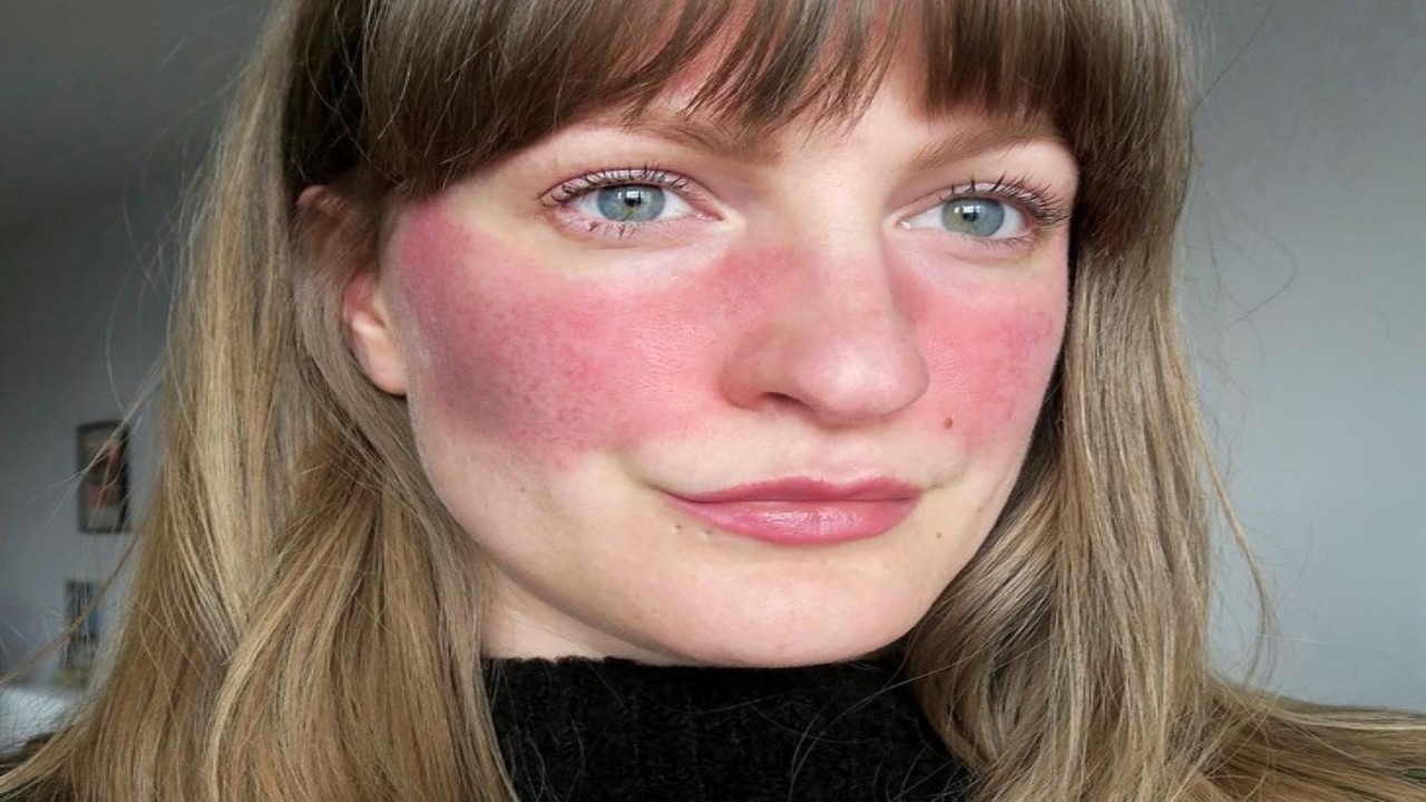 احمرار الوجه يشير إلى مرض جلدي خطير