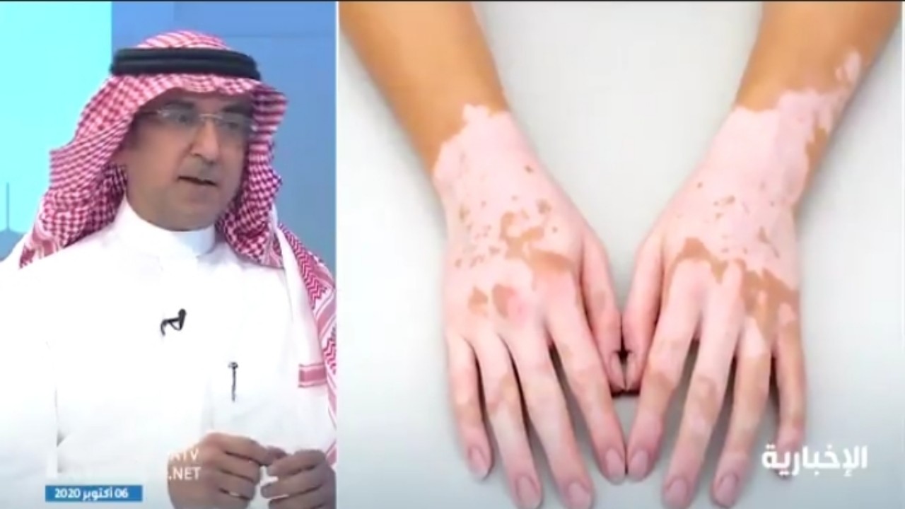 بالفيديو.. استشاري أمراض جلدية: البهاق لا ينتقل بالعدوى