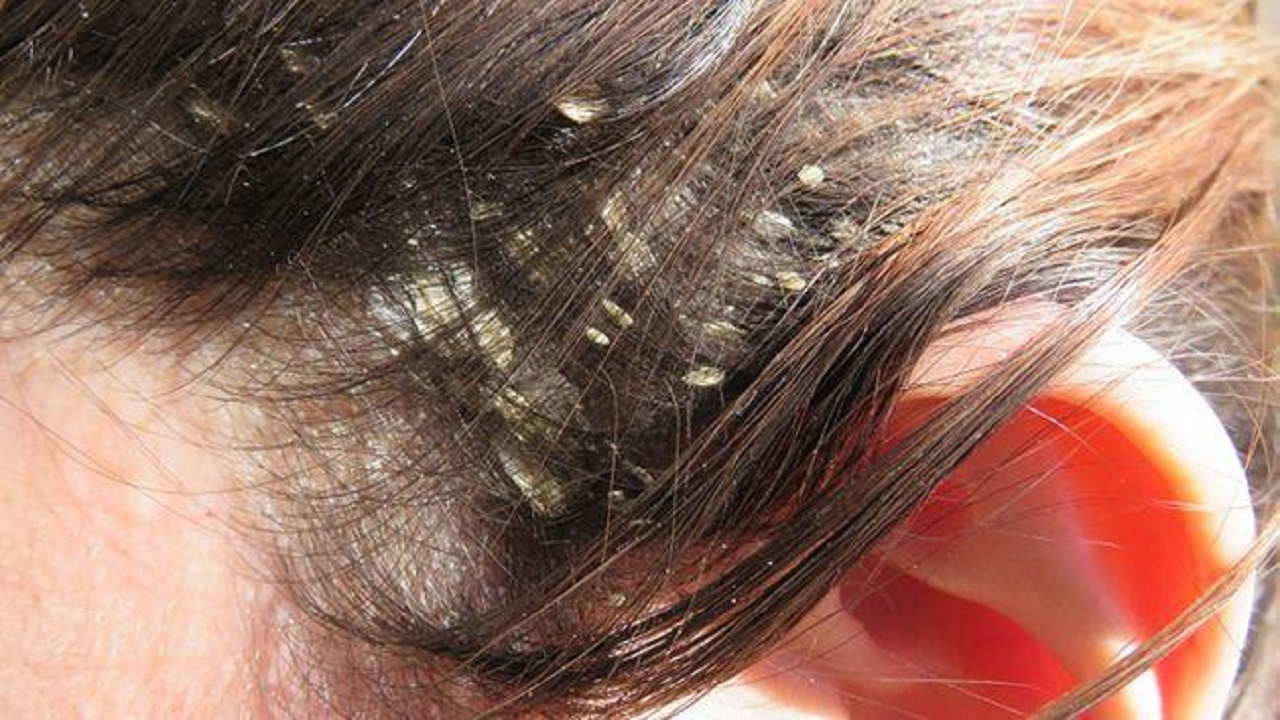 خطورة استخدام الزيوت لعلاج قشرة الشعر