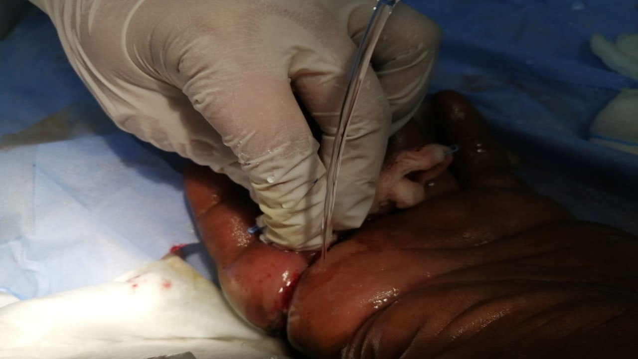 فريق طبي بمستشفى المويه ينجح في استخراج قطعة”حديد”من اصبع مريض