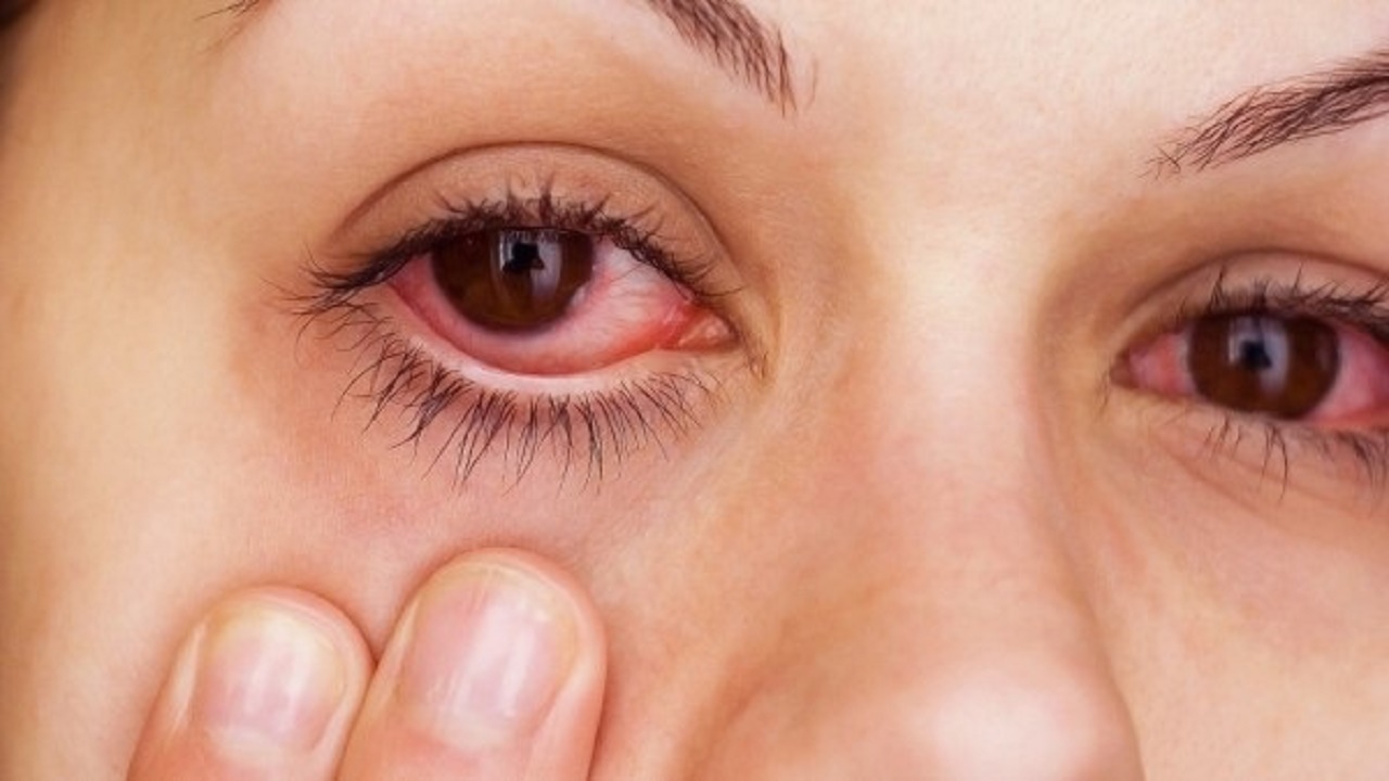 جفاف العين قد يكون علامة لـ “التهاب المفاصل”