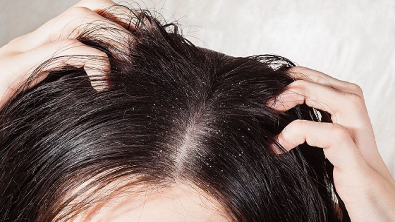 تحذير: قشرة الشعر علامة خطيرة على مرض معوي