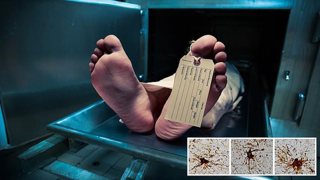 دراسة: &#8220;خلايا زومبي&#8221; تظل حية في مخ الإنسان بعد الوفاة