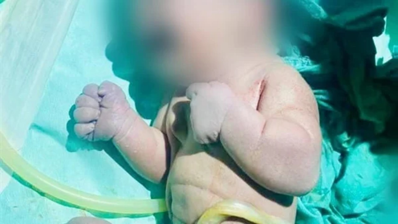 ولادة طفل بمتلازمة حورية البحر في الأقصر 