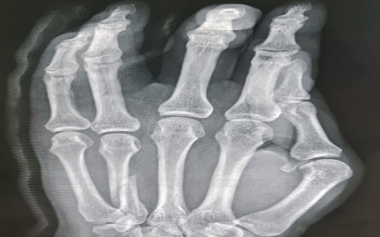 مستشفى حريملاء ينجح في جراحة دقيقة لمواطن خمسيني