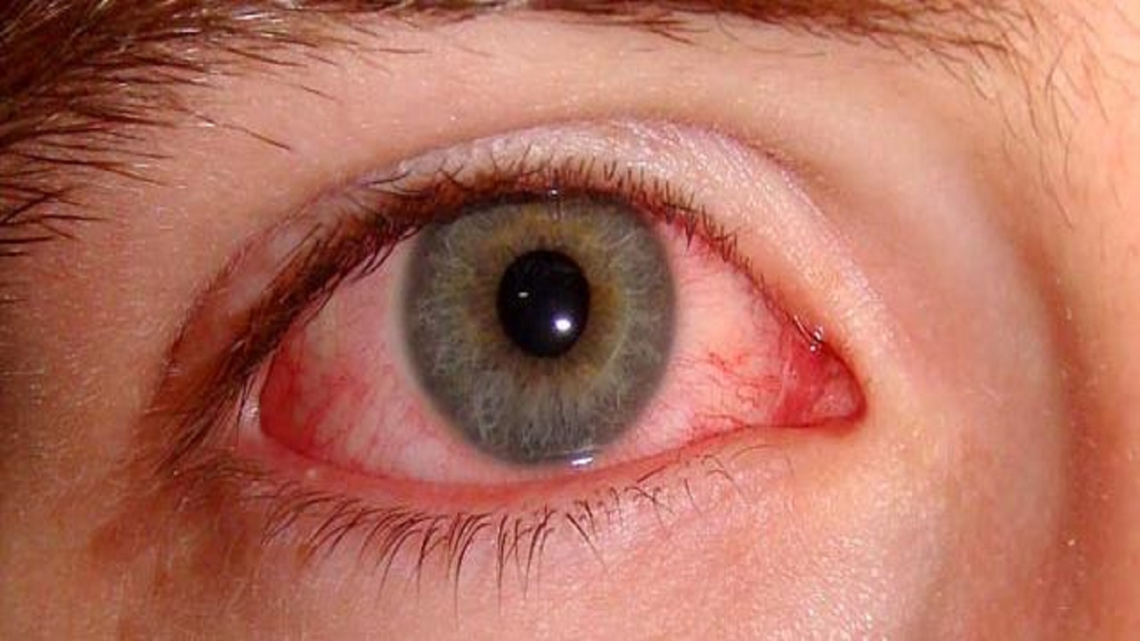 &#8221; فهد الطبية &#8221; : 6 عوامل تزيد احتمالات إصابة العين بتمزق الأوعية الدموية