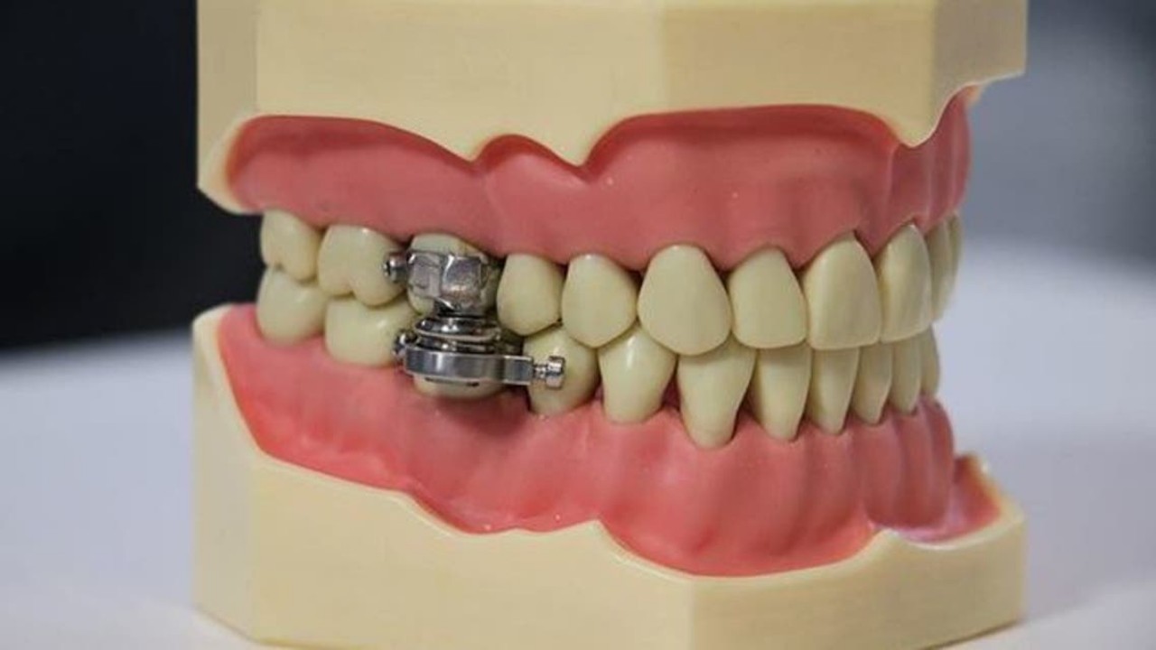 ابتكار «قفل للأسنان» لإنقاص الوزن