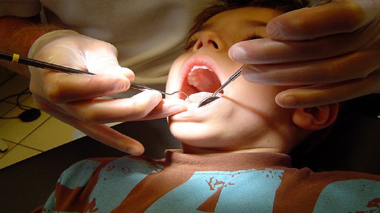 ما لا تعرفه عن الحشوات السادة اللاصقة للأسنان عند الأطفال