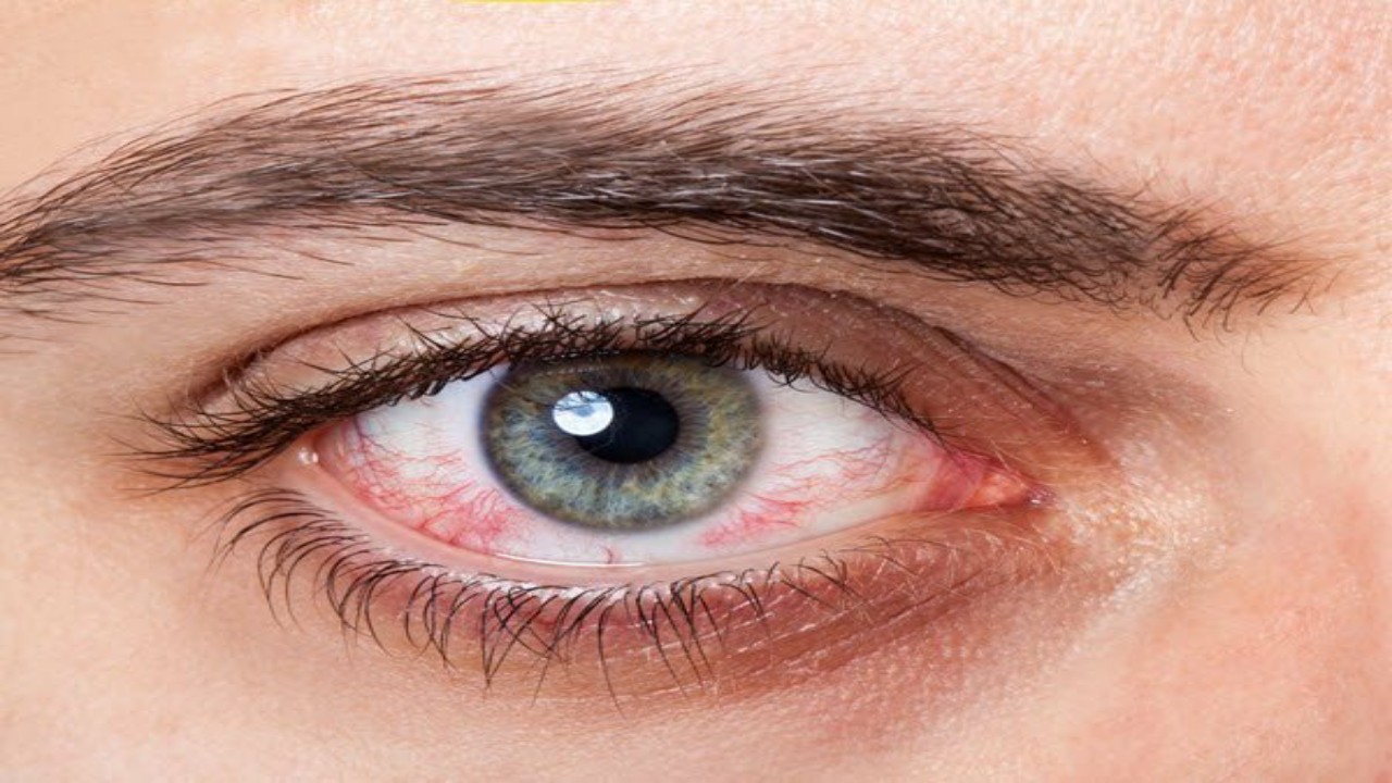 جفاف العين والرؤية المشوية تشير لأمراض مزمنة