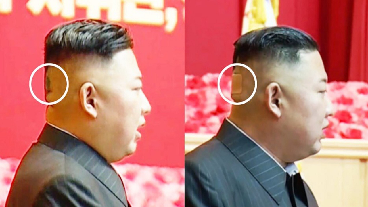 ظهور زعيم كوريا الشمالية بكدمة وضمادة الجروح على رأسه