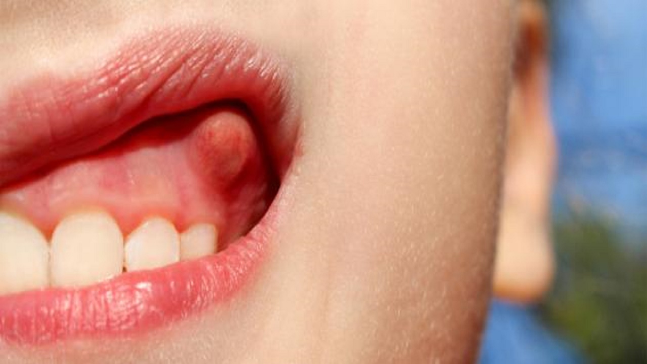 خطورة التأخر في علاج خراج الفم عند الأطفال