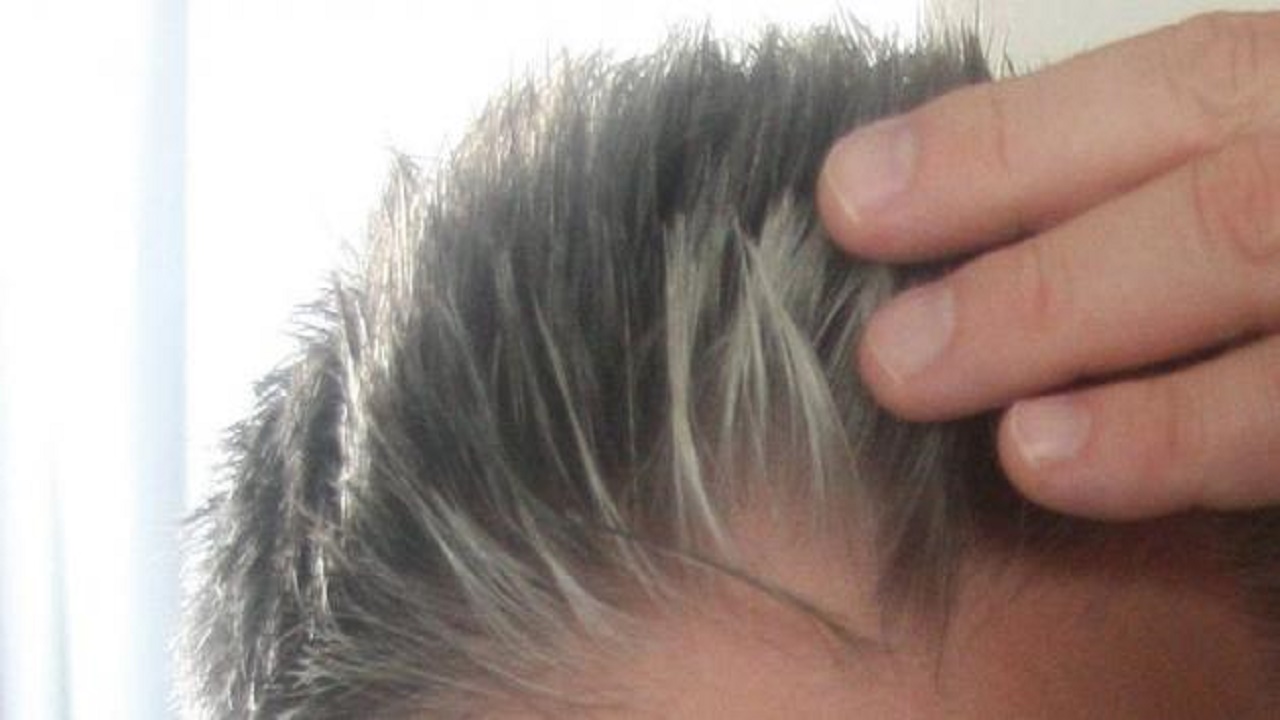 نقص الفيتامينات من أسباب شيب الشعر في مرحلة الشباب