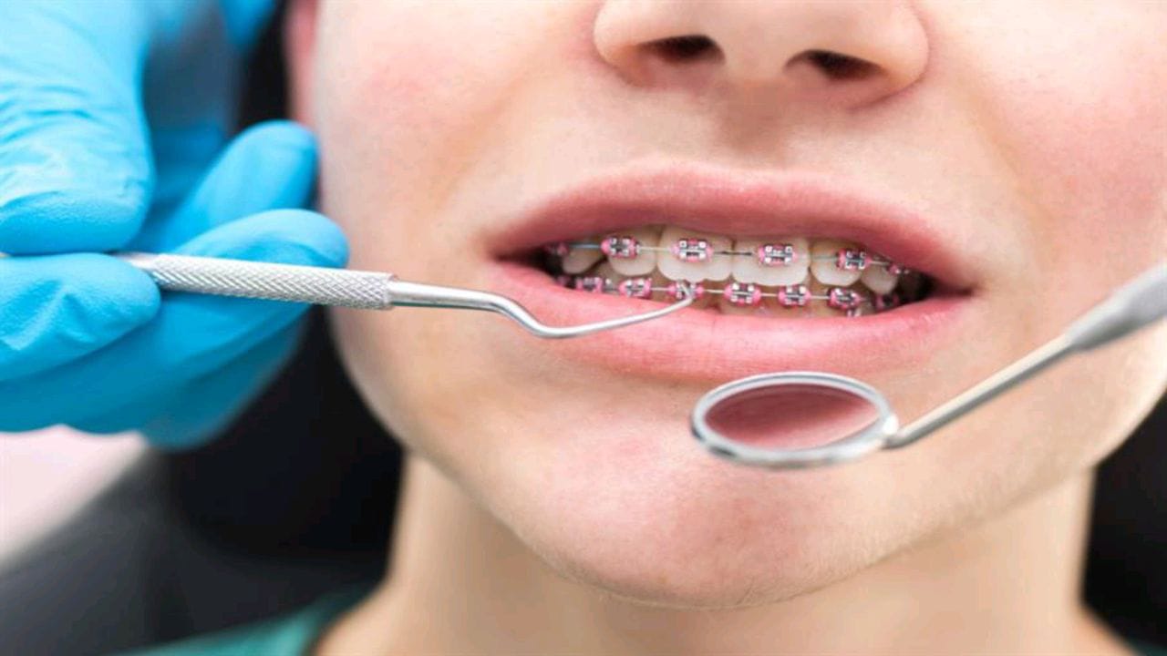 أهمية مثبت تقويم الأسنان الداخلي الثابت وكيفية المحافظة عليه