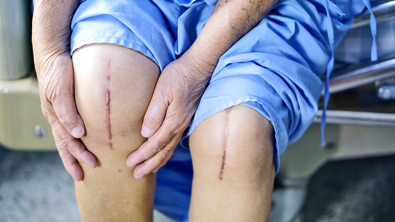 شاهد .. تقنية جديدة لعملية “استبدال الركبة” تخفف الألم وتحقق نتائج مبهرة